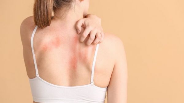 तेज गर्मी में घमौरियों से बचने के लिए अपनाएं ये असरदार घरेलू उपाय&hellip;